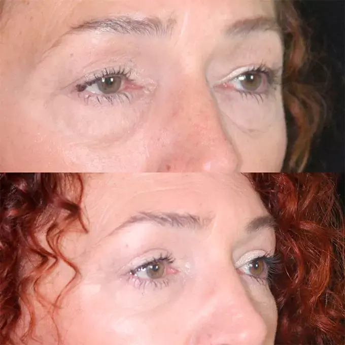 precio blefaroplastia en fuengirola