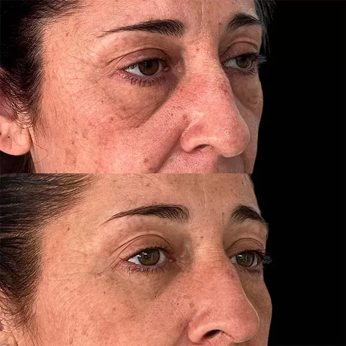 mejor cirujano blefaroplastia estepona