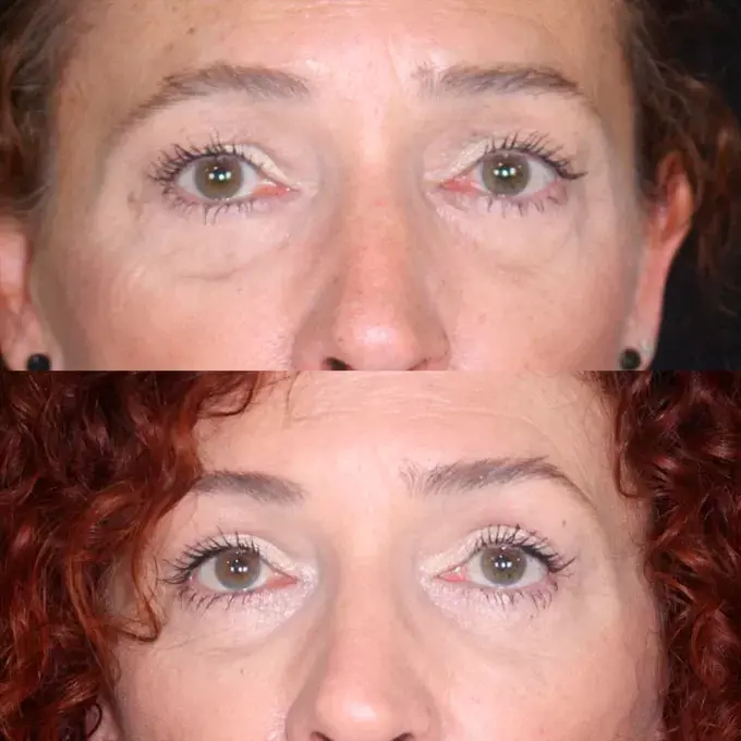 resultados de blefaroplastia en estepona