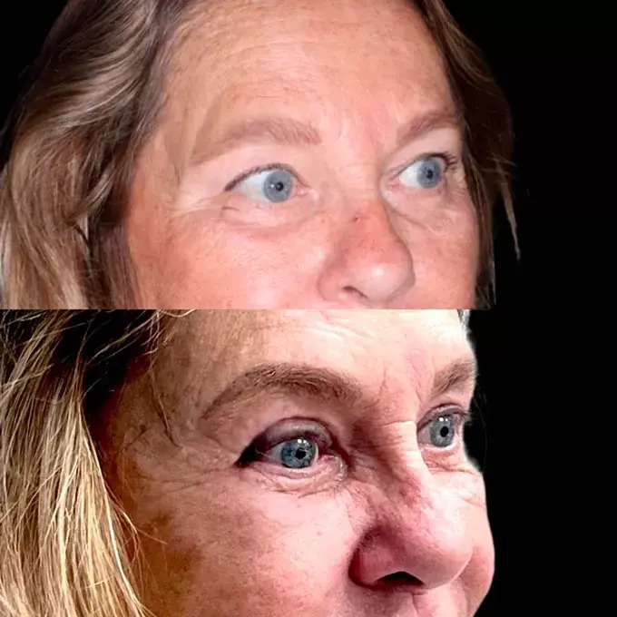 blefaroplastia precio mijas