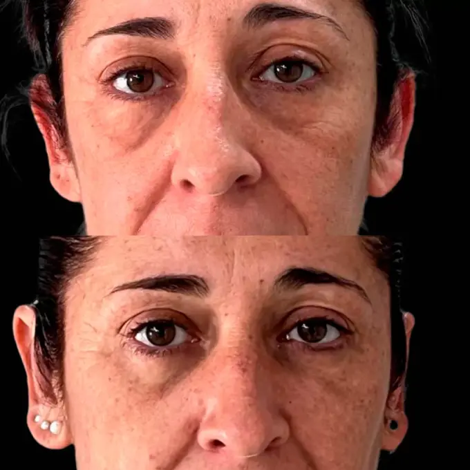 blefaroplastia antes y despues mijas